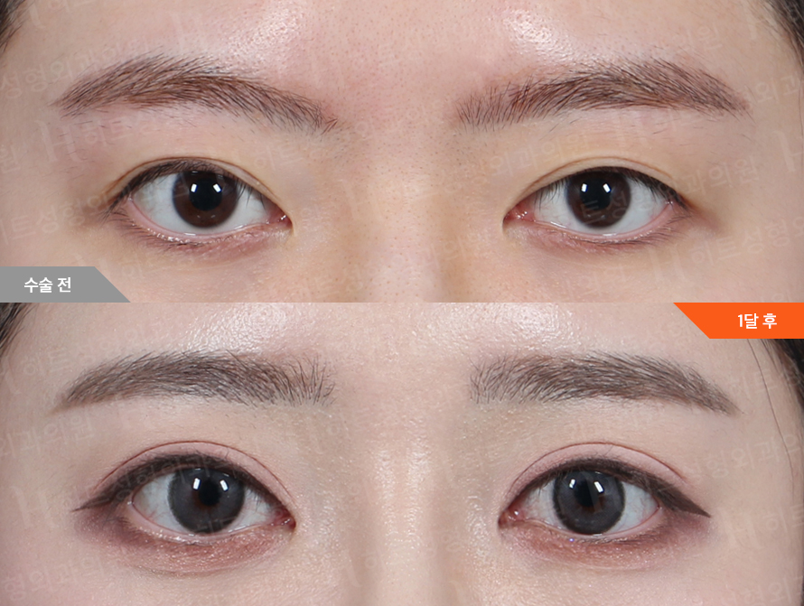 Before