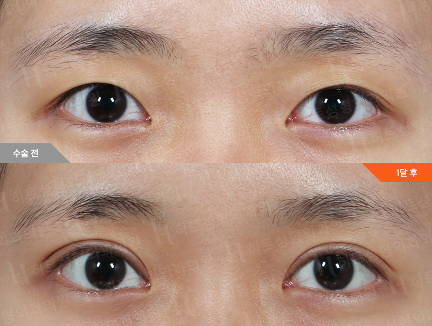 Before