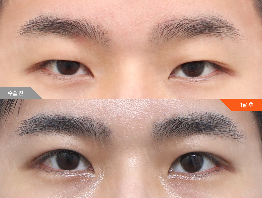 Before
