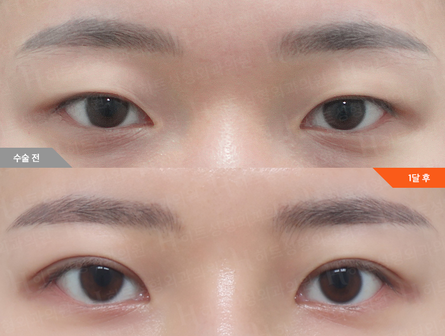 Before