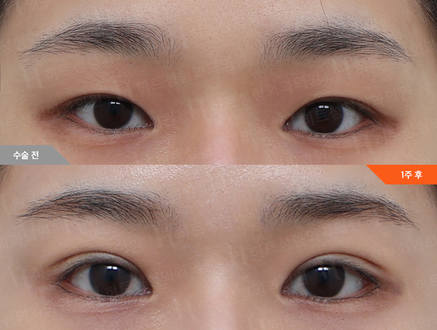 Before