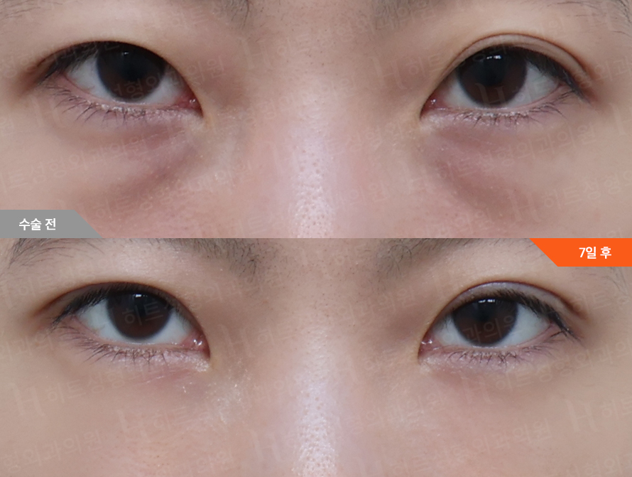 Before