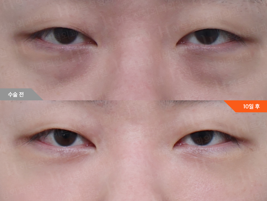 Before
