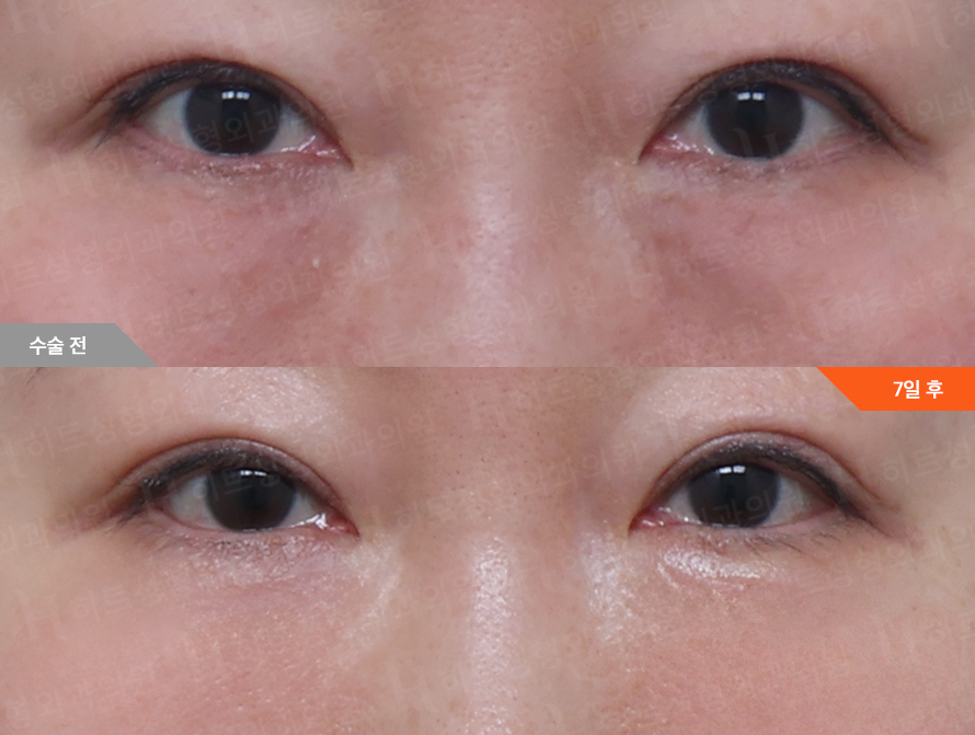 Before