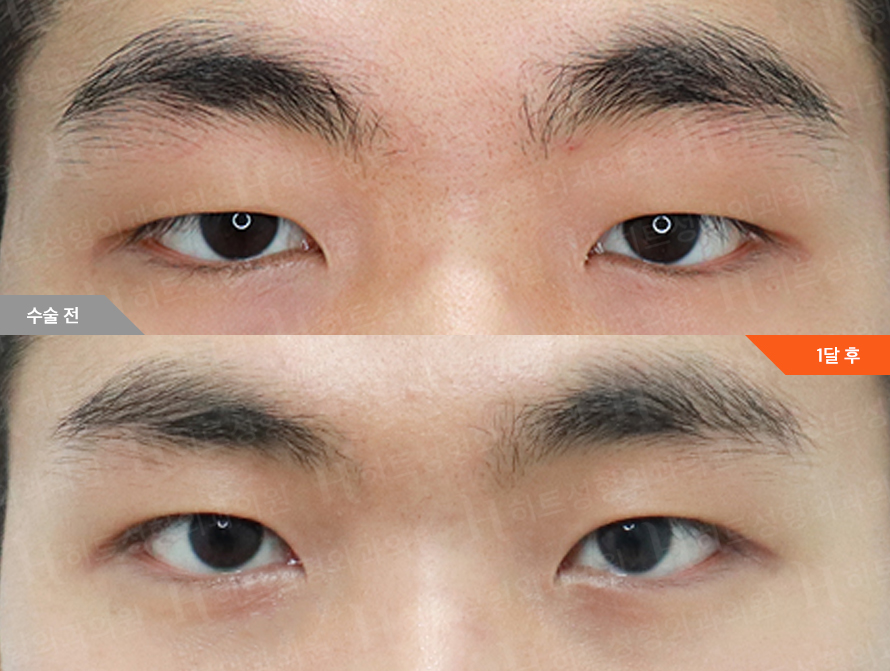 Before