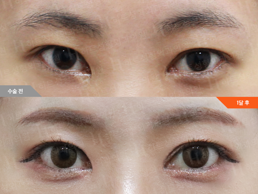 Before