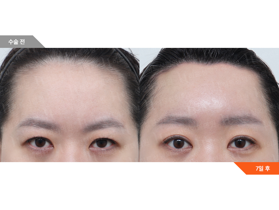 Before