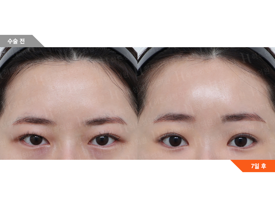 Before