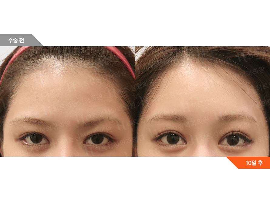 Before