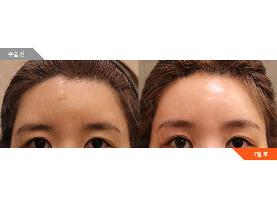 Before