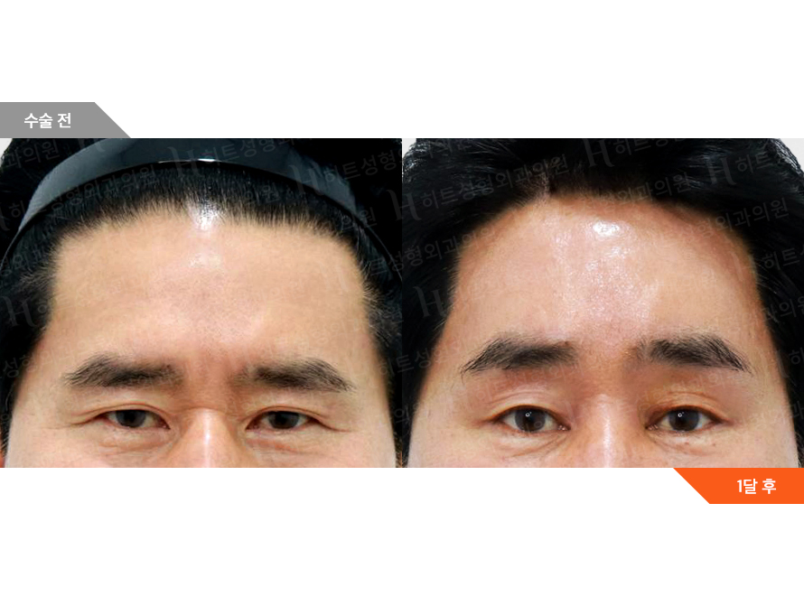 Before